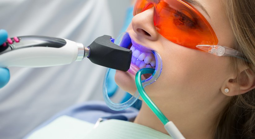 Bleaching - MDDr. Antonia Kupec - Zahnärztin Dornbirn 6850