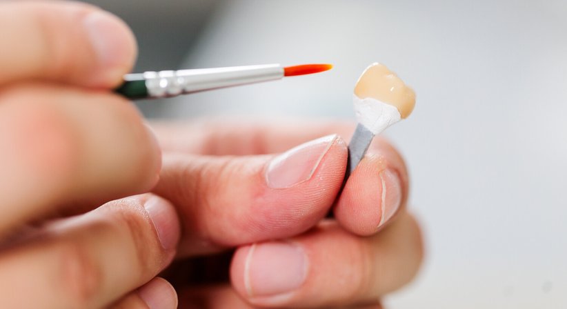 Kronen und Brücken  - MDDr. Antonia Kupec - Zahnärztin Dornbirn 6850