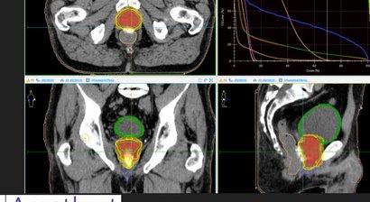 Prostatakrebstherapie ohne OP 