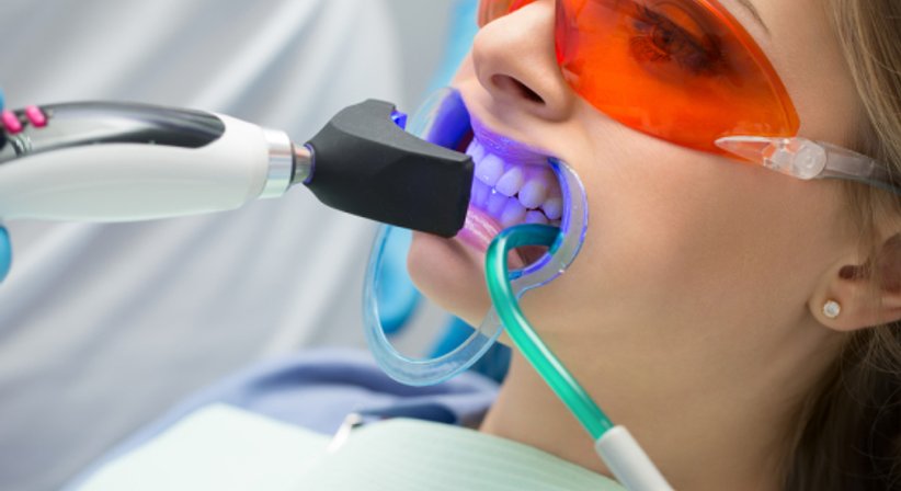 Bleaching - Dr. Ulrike Leiner-Grassner - Zahnärztin Linz 4020