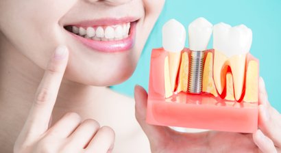 Implantate / Knochenaufbau