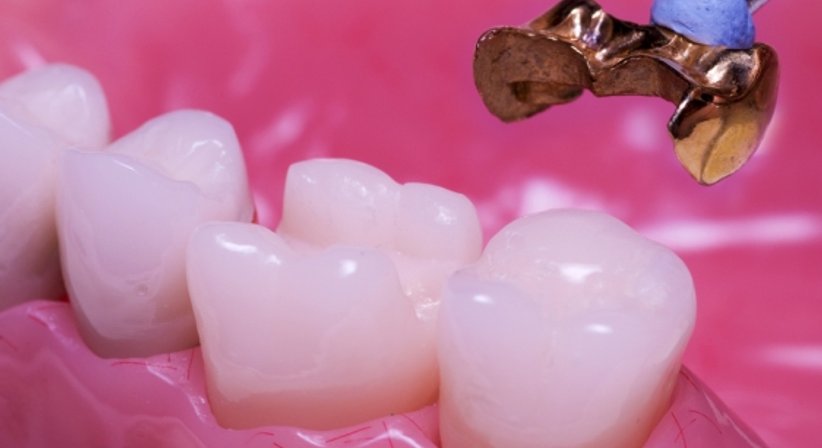 Kronen / Brücken - Dr. Ulrike Leiner-Grassner - Zahnärztin Linz 4020