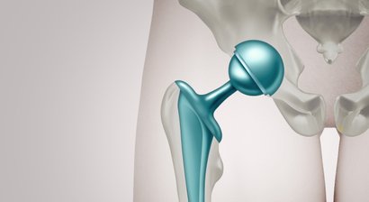 Krankheitsbilder des Hüftgelenks
