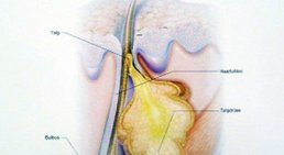 Aknetherapie -