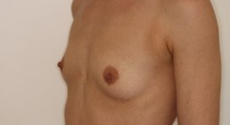 Brustoperation -