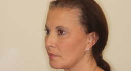 Facelift -