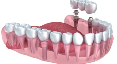 Implantologie und Keramikimplantate