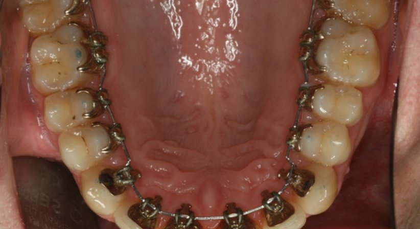 Unsichtbare Zahnspange - Dr. Stephan Hinz - Zahnarzt Salzburg 5020