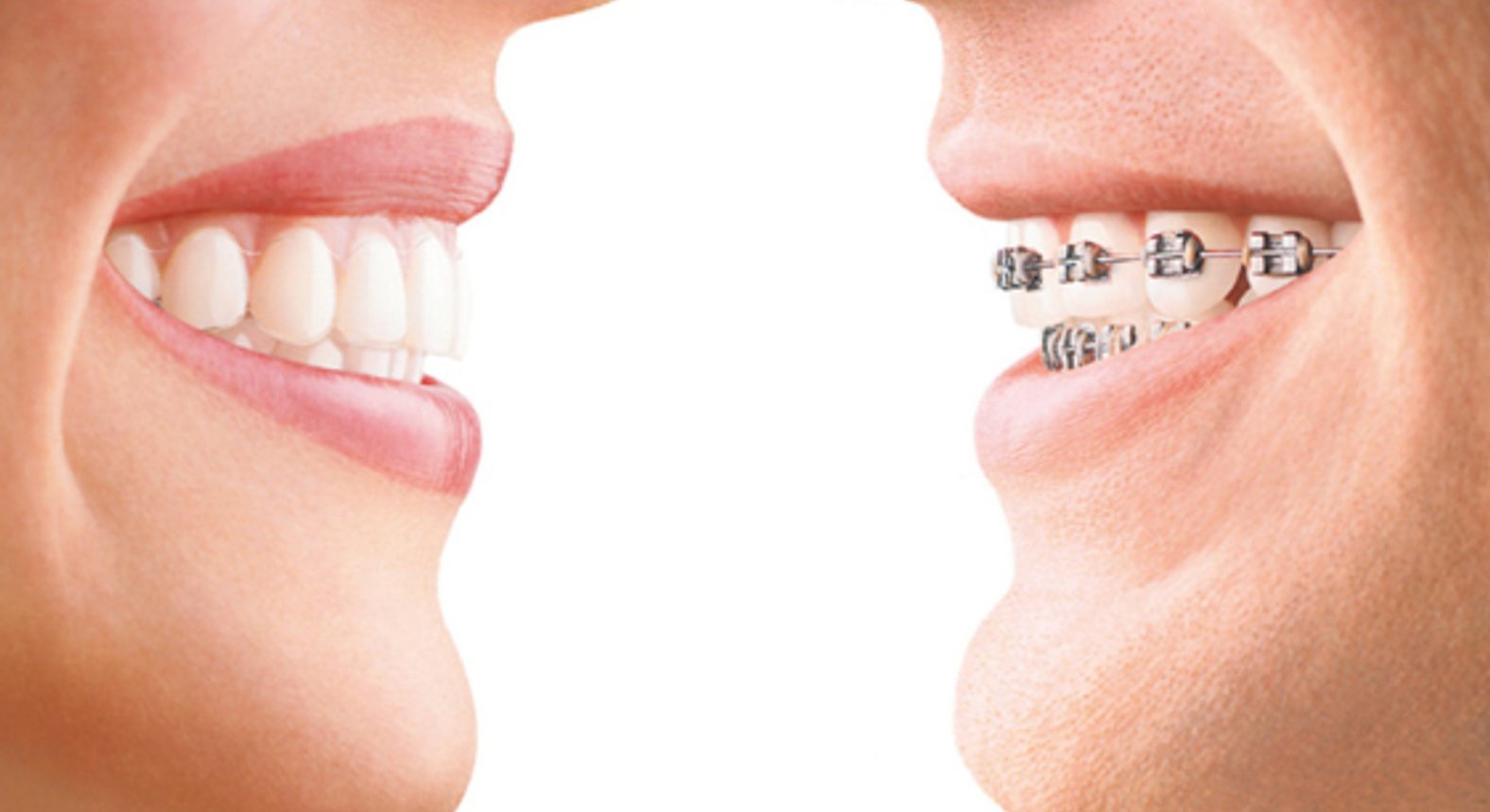 Wie Bekommt Man Eine Zahnlücke Weg Ohne Zahnspange Dr. Stephan Hinz - Unsichtbare Zahnspange | Zahnarzt in 5020 Salzburg
