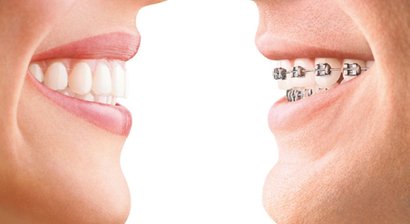 Unsichtbare Zahnspange