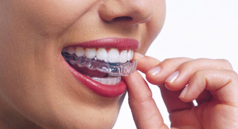 Unsichtbare Zahnspange - Dr. Stephan Hinz - Zahnarzt Salzburg 5020