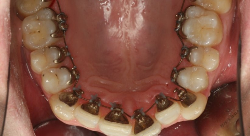 Unsichtbare Zahnspange - Dr. Stephan Hinz - Zahnarzt Salzburg 5020