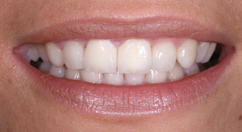 Veneers - Dr. Stephan Hinz - Zahnarzt Salzburg 5020