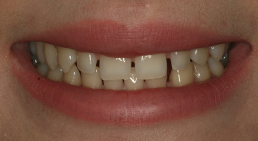 Veneers - Dr. Stephan Hinz - Zahnarzt Salzburg 5020