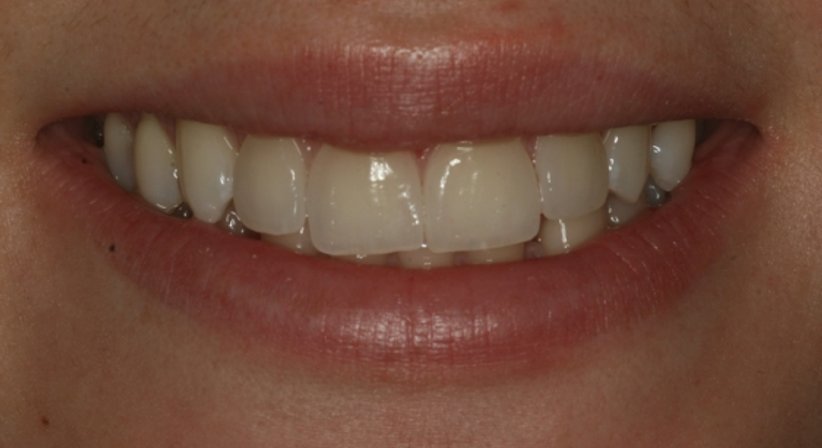 Veneers - Dr. Stephan Hinz - Zahnarzt Salzburg 5020