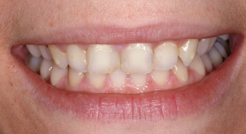 Veneers - Dr. Stephan Hinz - Zahnarzt Salzburg 5020