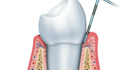 Zahnfleischerkrankungen