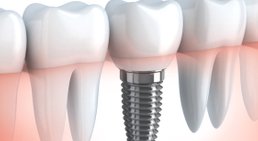 Implantologie -