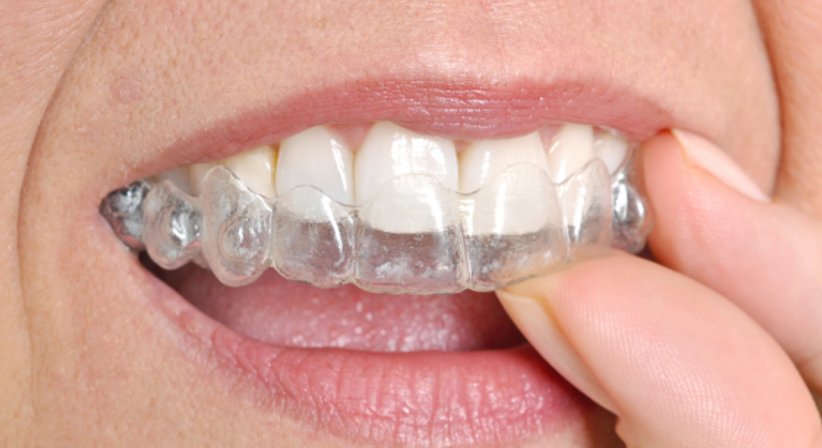 Invisalign - Dr. Sibylle Hainich - Zahnärztin Wien 1170