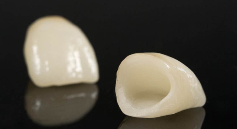 Zahnkrone - Dr. Sibylle Hainich - Zahnärztin Wien 1170