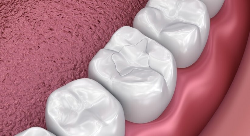 Konservierende Zahnheilkunde - Dr. Oliver Steinwendtner, MM.Sc. - Zahnarzt Wien 1020