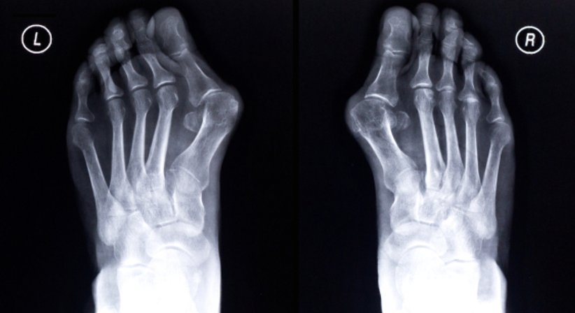 Fußchirurgie - Dr. Roland Meizer - Orthopäde Wien 1050