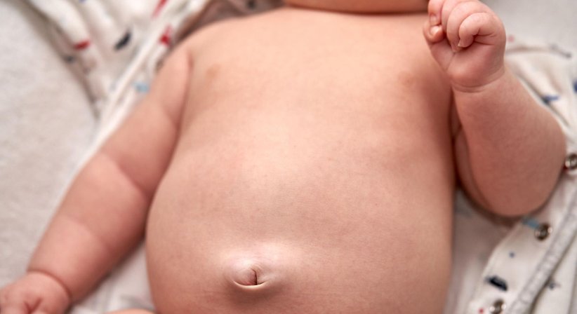 Nabelbruch - OÄ. DDr. Valeria Solari, MRCS - Kinderchirurgin Wien 1220