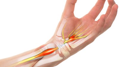 Karpaltunnelsyndrom