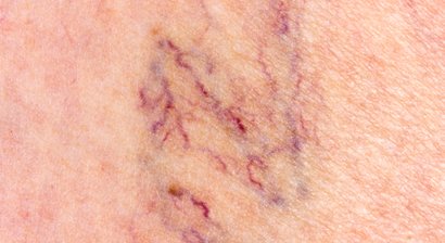 Behandlung von Besenreisern und Krampfadern