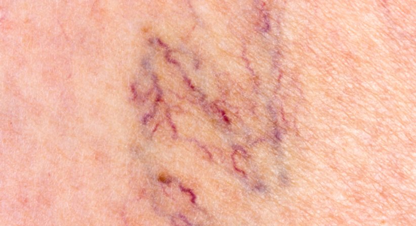 Behandlung von Besenreisern und Krampfadern - Dr. Eva Maria Zito - Praktische Ärztin Wien 1030