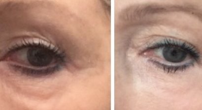 Chirurgisches Plasma