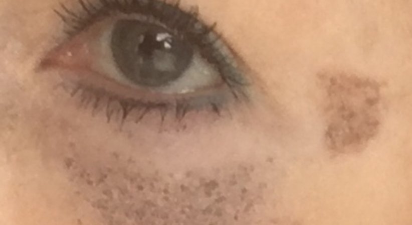 Chirurgisches Plasma - Dr. Eva Maria Zito - Praktische Ärztin Wien 1030