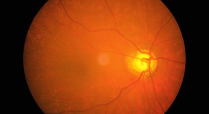 Diabetische Retinopathie