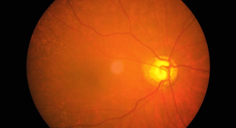 Diabetische Retinopathie - OA Dr. Franz Dirisamer junior, FEBO - Augenarzt Gmunden 4810