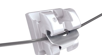 Außenliegende Zahnregulierung mit Clear Brackets