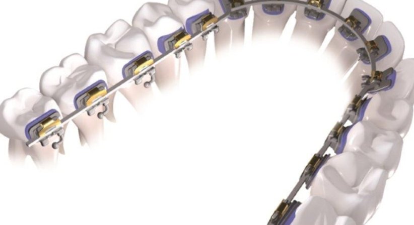 Innenliegende Zahnregulierungen - Dr. Maija Eltz - Zahnärztin Wien 1010