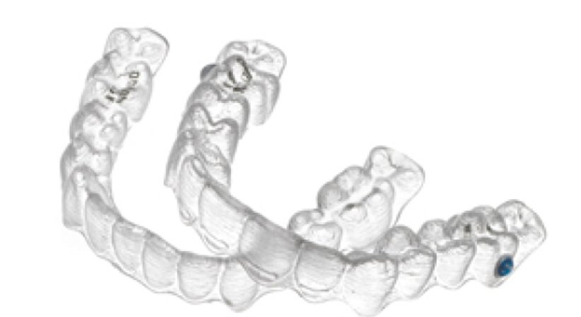 Invisalign - die unsichtbare Zahnspange - Dr. Maija Eltz - Zahnärztin Wien 1010