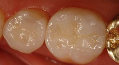 Keramik Inlay, Gold Inlay, Komposit- / Kunststoff Füllung