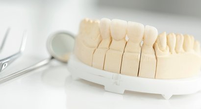 Vollkeramikronen, Brücken, Veneer