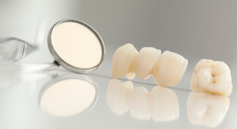 Vollkeramikronen, Brücken, Veneer - Dr. med. univ. Robert Horvath - Zahnarzt Graz 8010