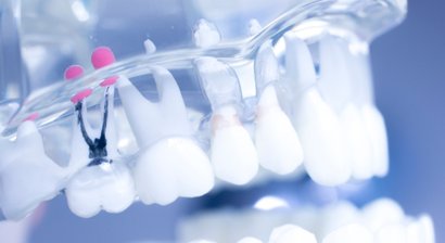 Wurzelbehandlung / Endodontie