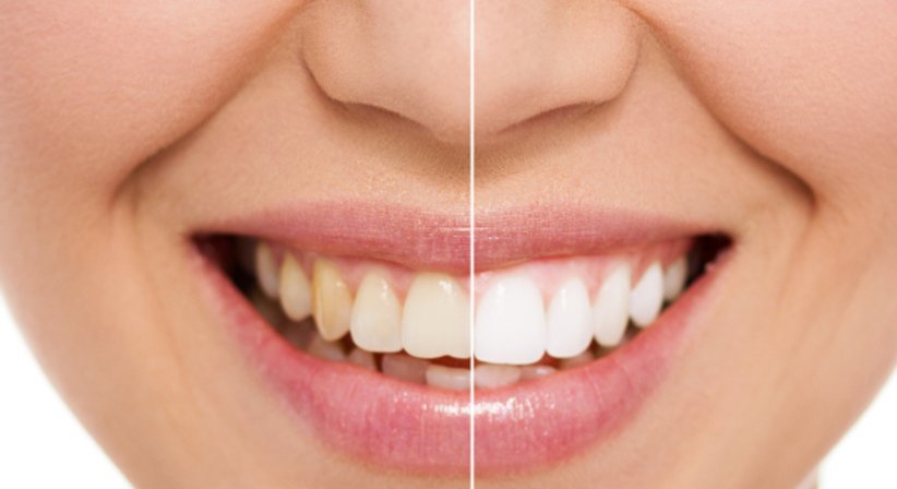 Zahnaufhellung / Bleaching - Dr. med. univ. Robert Horvath - Zahnarzt Graz 8010