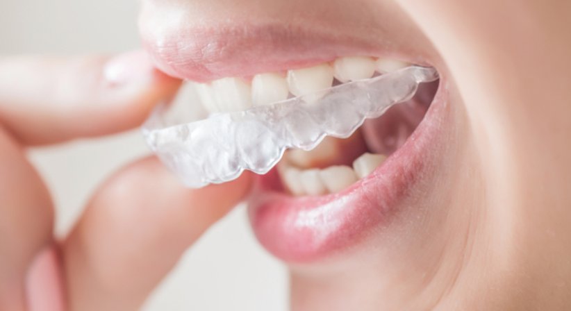 Zahnaufhellung / Bleaching - Dr. med. univ. Robert Horvath - Zahnarzt Graz 8010