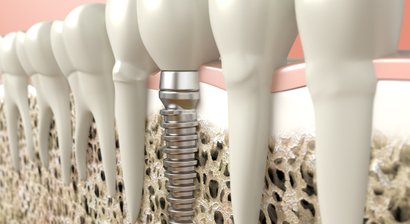 Zahnimplantate