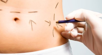 Bauchdeckenstraffung