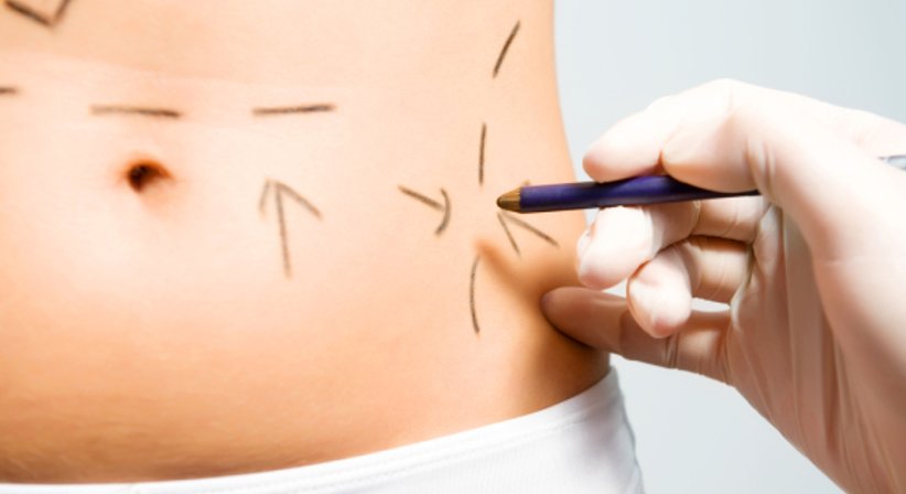 Bauchdeckenstraffung - Dr. Harald Beck - Plastischer Chirurg Wien 1010