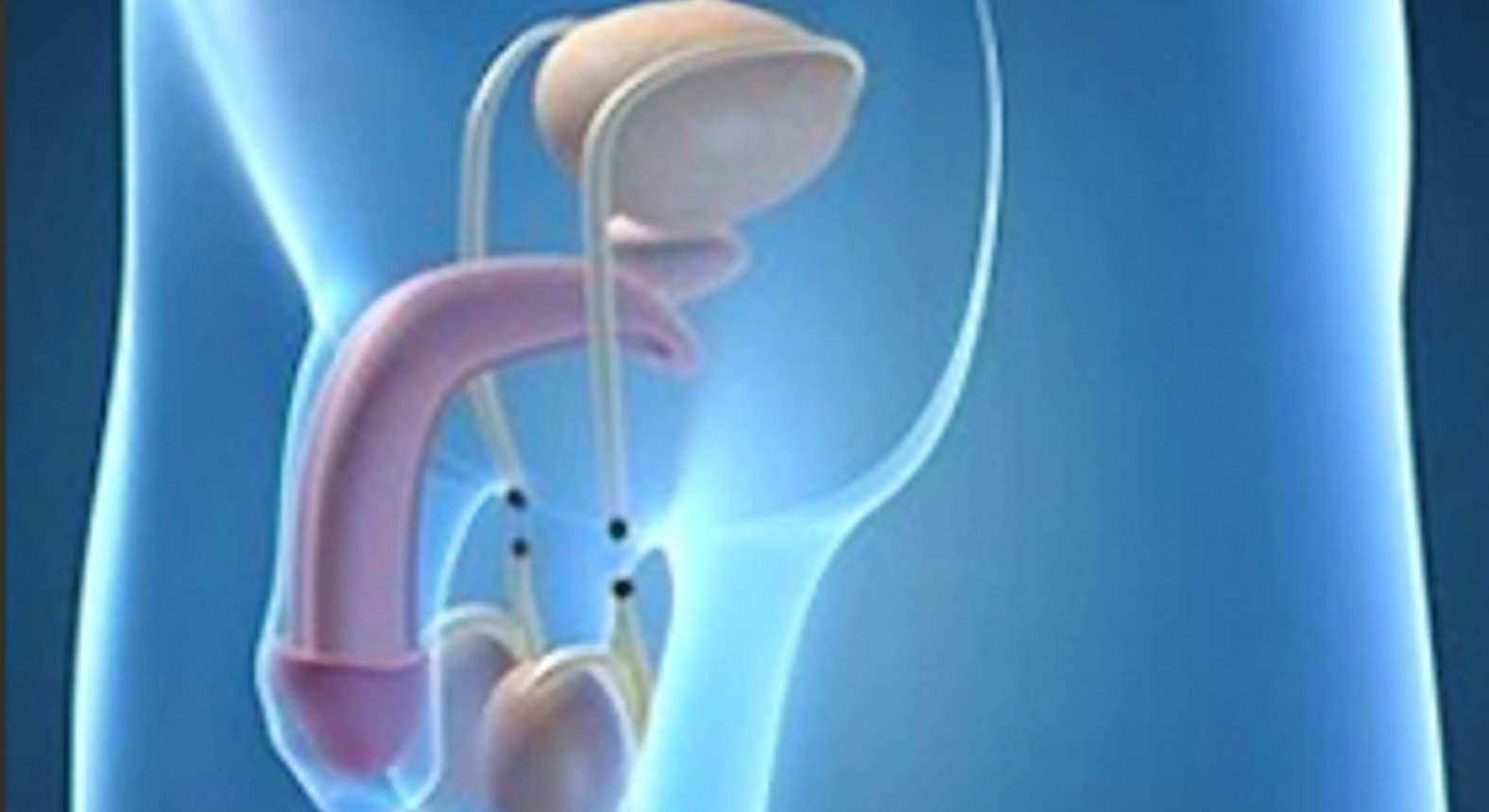 Priv. Doz. Dr. Christopher Springer, MBA - Vasektomie (Verhütung