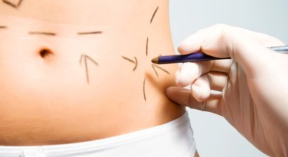 Bauchdeckenstraffung