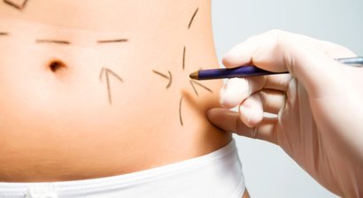 Bauchdeckenstraffung