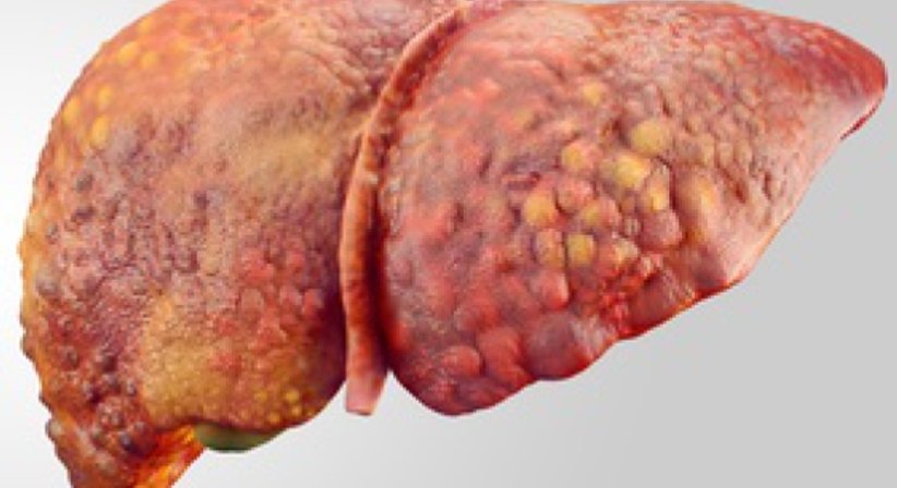 Leberzirrhose - OA Dr. Gregor Ulbrich - Internist Wien 1080